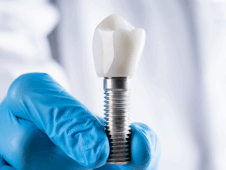 dental implants dental implants
