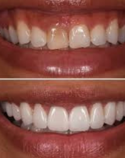 teeth transformation