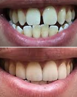 teeth transformation