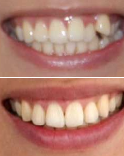 teeth transformation