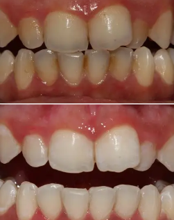 teeth transformation